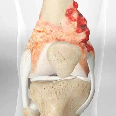 osteosarcoma cancer