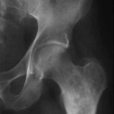 chondrosarcoma cancer